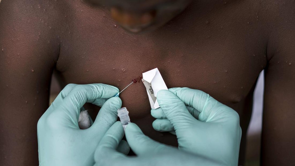 mpox anak Mpox Anak Meningkat di Guinea-Bissau, Vaksinasi Terhambat mpox anak - ilustrasi berita Mpox Anak Meningkat di Guinea-Bissau, Vaksinasi Terhambat