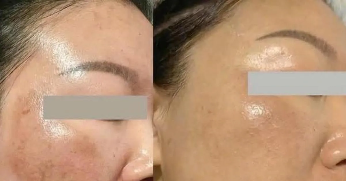 serum untuk noda 5 Serum untuk Noda Nám yang Bisa Membuat Kulit Lebih Cerah… serum untuk noda - ilustrasi berita 5 Serum untuk Noda Nám yang Bisa Membuat Kulit Lebih Cerah dalam Sekitar 4 Minggu